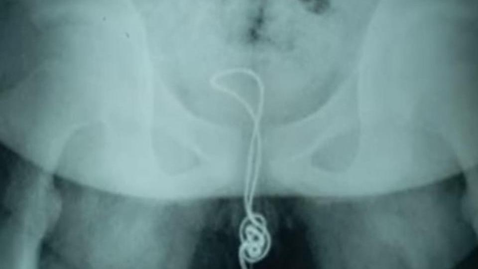 Aus Neugierde: Junge (13) schiebt sich USB-Kabel in seinen Penis – Klinik Röntgenbild: USB-Kabel in Penis