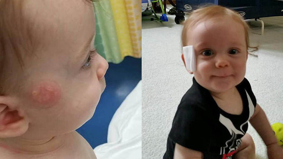 Schnuller verursacht Saugverbrennung: Mutter warnt andere Eltern auf Facebook Baby Jack aus Michigan erlitt Brandblasen, weil sich sein Schnuller nachts an seiner Wange festsaugte. Jetzt warnt die Mutter andere Eltern auf Facebook.