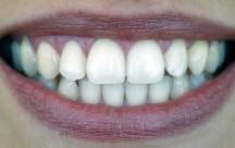 Bleaching: Zähne aufhellen muss nicht viel kosten Bleaching macht die Zähne weiß - diese Methoden gibt es.