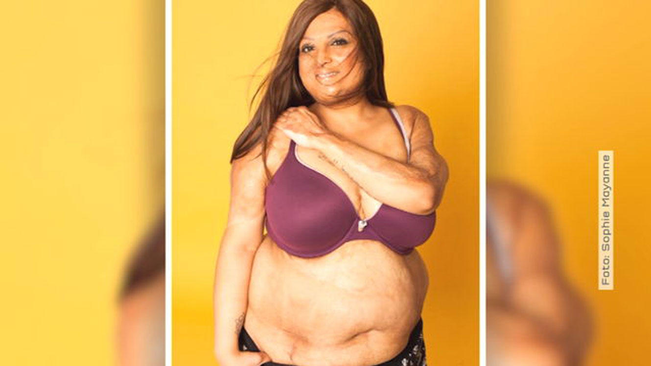 Sexy trotz Narben: Deborah und Tulsi wollen sich nicht mehr verstecken Tulsi Vagjiani