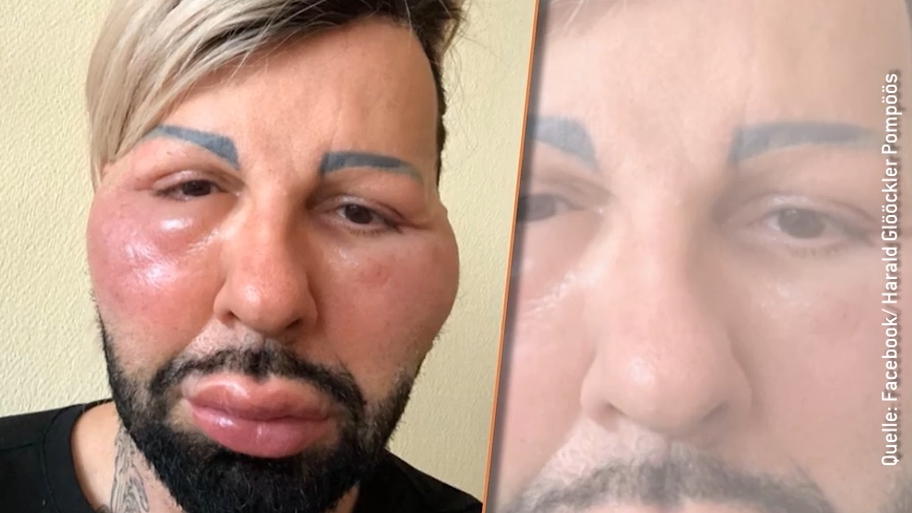 Huch, was ist denn mit Harald Glööckler passiert? Huch, was ist denn mit Harald Glööckler passiert?