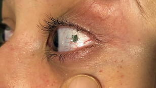Verrückte Schönheits-OPs für Augen Verrückte Schönheits-OPs für Augen
