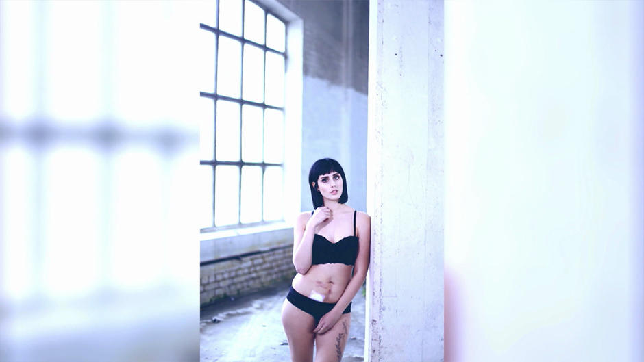 Jeder darf sich sexy fühlen – trotz Narben Jeder darf sich sexy fühlen – trotz Narben