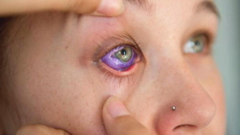 Augapfel-Tattoo ging schief Augapfel-Tattoo ging schief