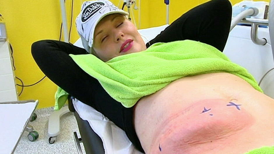 Cool Sculpting: Fett einfach wegfrieren Cool Sculpting: Fett einfach wegfrieren