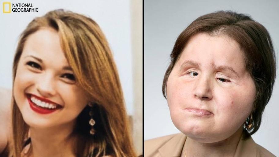 Transplantation: Ärzte schenken Katie ein neues Gesicht Transplantation: Ärzte schenken Katie ein neues Gesicht
