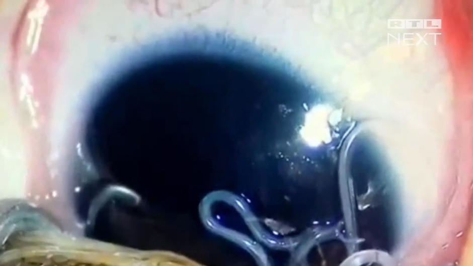 Baby wurden elf lebende Würmer aus dem Auge entfernt Baby wurden elf lebende Würmer aus dem Auge entfernt