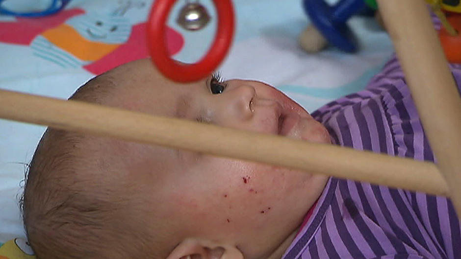 Neurodermitis Baby Was Sie gegen Ausschlag und Juckreiz tun können RTL.de