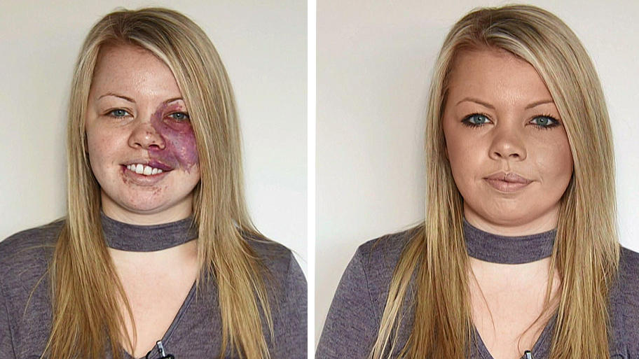 Mehr Selbstbewusstsein dank Makel Amy Elsegood Ihr Feuermal macht sie