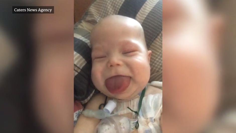 Beckwith-Wiedemann-Syndrom: Baby mit Riesen-Zunge benötigt Operation ...