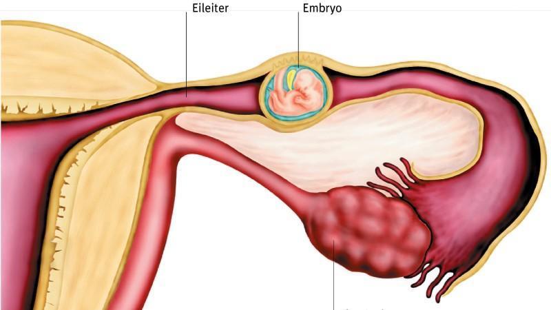Schwangerschaft außerhalb des Uterus: Eileiterschwangerschaf