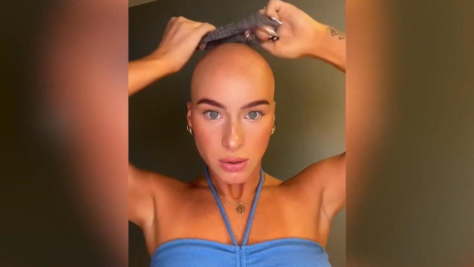 Früher wegen Alopecia gemobbt, heute Unternehmerin: TikTok-Star Chloe